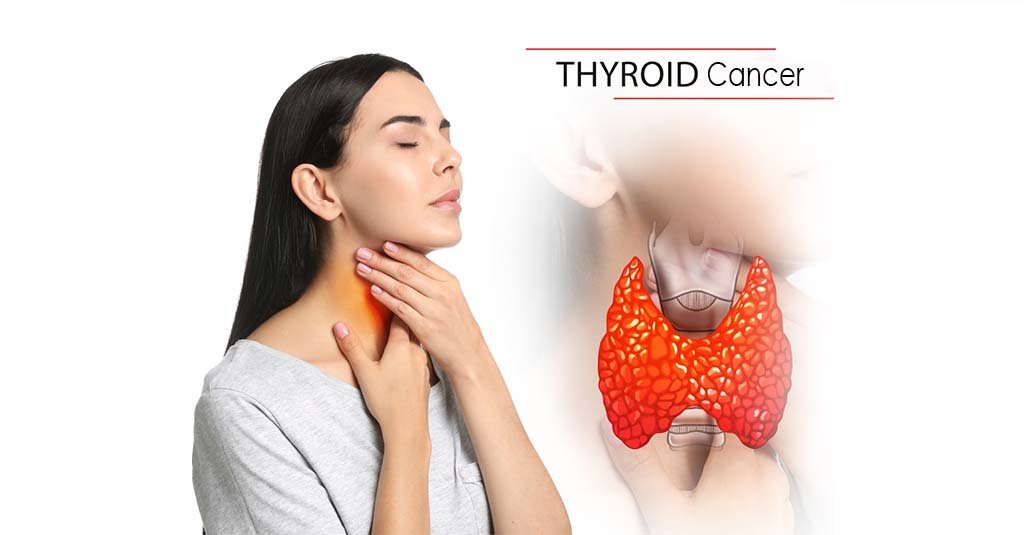 Thyroid Cancer